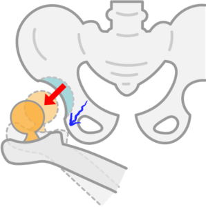 股関節が脱臼する仕組みを説明した画像