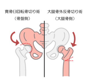 変形性股関節症の手術療法のひとつ、骨切り術の手術方法の違いを示した画像