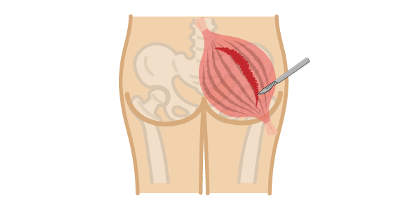 股関節の脱臼に深く関係のある筋肉を切るイメージ画像