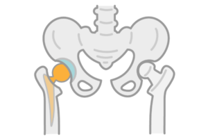 人工股関節を設置した股関節の画像