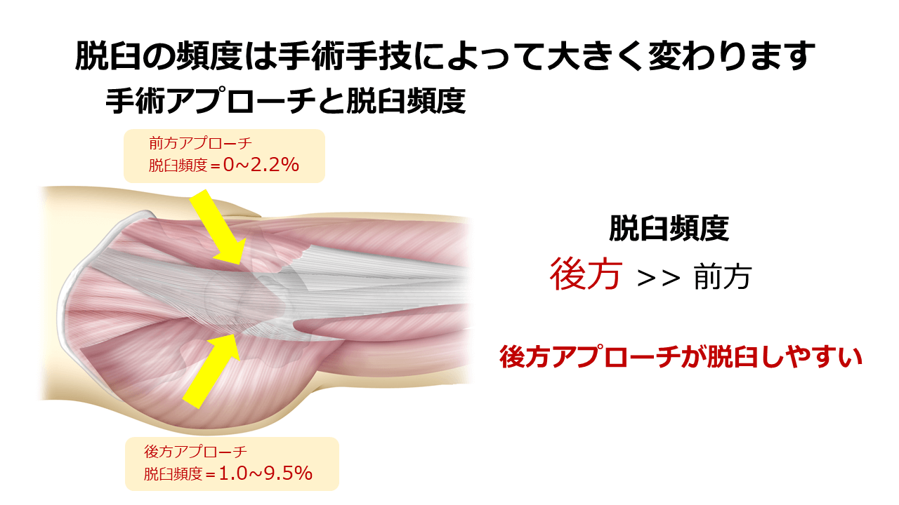 手術アプローチによって脱臼リスクが異なる 股関節専門ドクター 久留 隆史