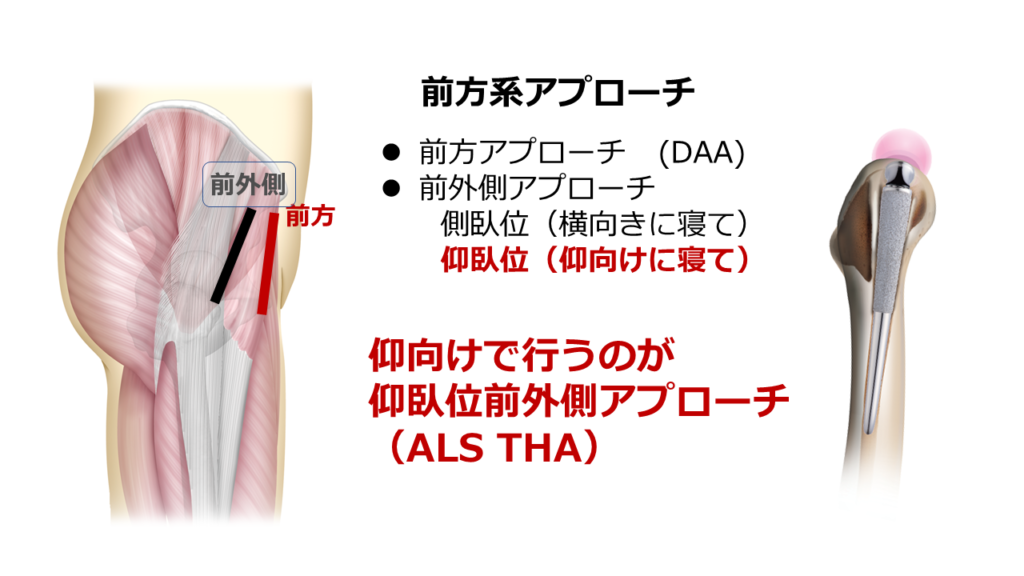  Foto zu Tha 後方アプローチ 手術手順 – 人工股関節全置換術 後方アプローチ 前方アプローチ – DPXP 
