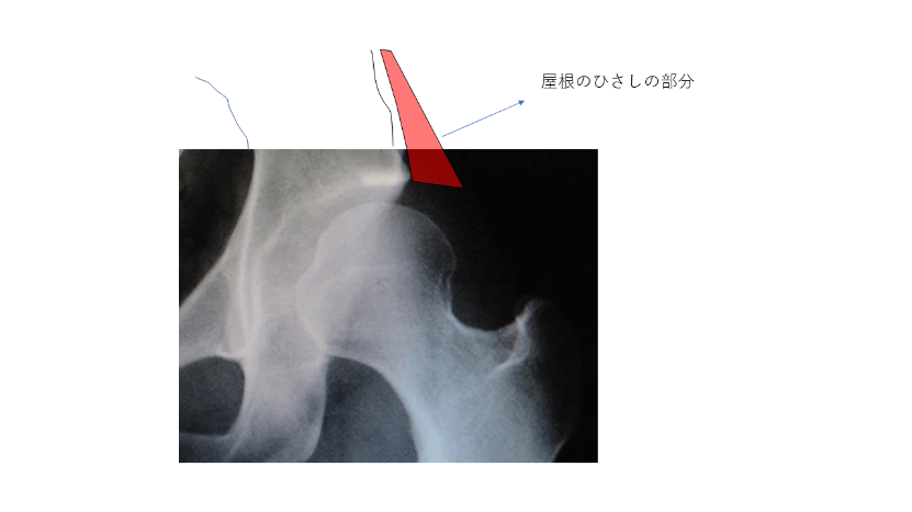 大腿骨頭の一部の張り出しが少ない臼蓋形成不全の説明図